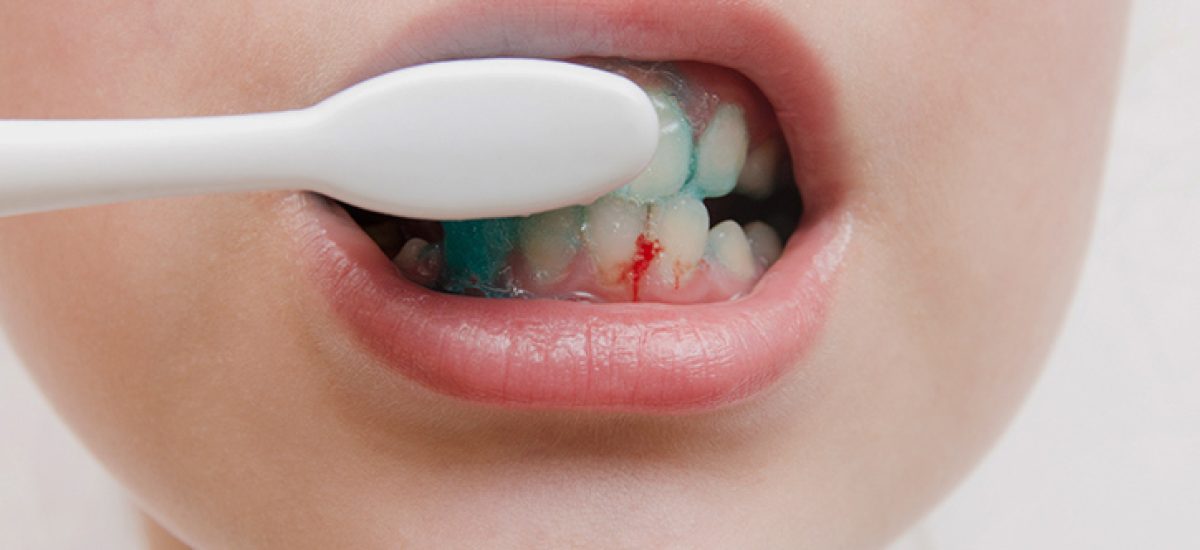 dientes-sangrando